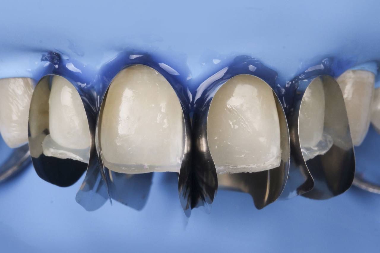 سکشنال ماتریکس قدامی یونیورسال DDS DENT